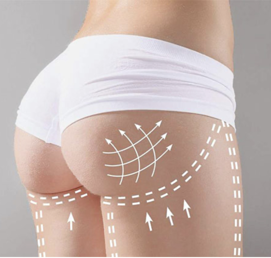 Buttock Lift w Cellulite Treatment