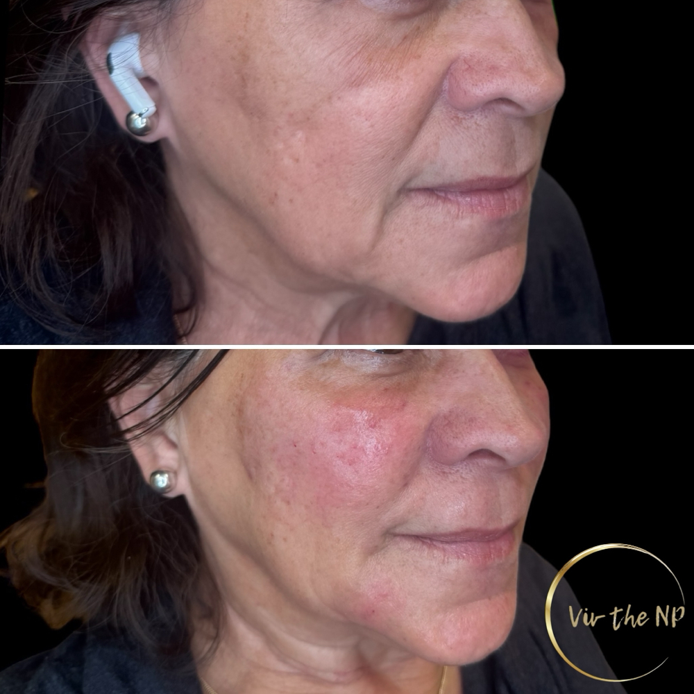 Dermal Fillers: Lips/cheeks/chin….