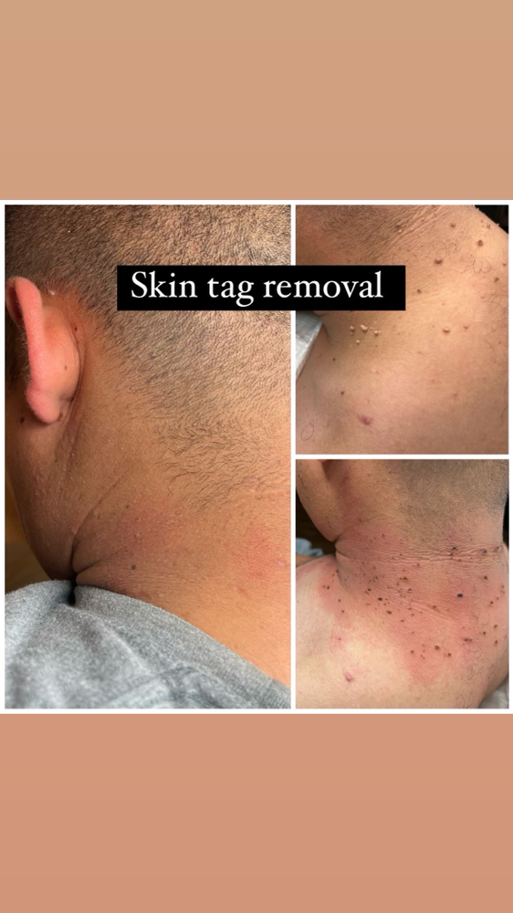 Skin Tag Removal