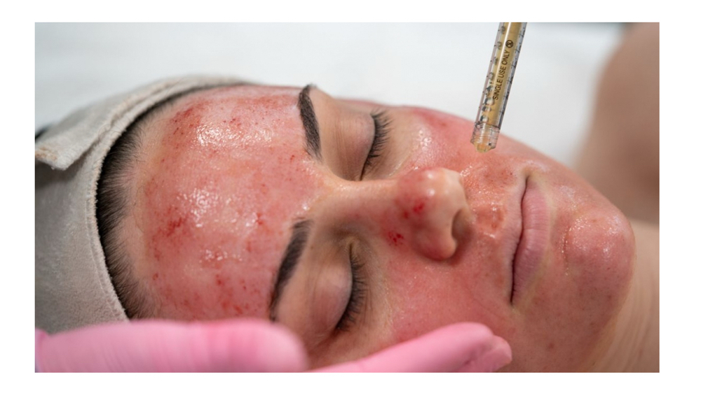 Microneedling With PRP