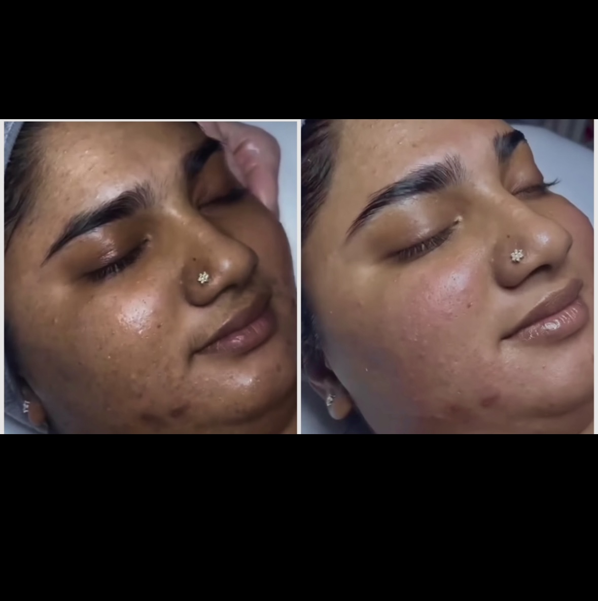 Hyperpigmentation/BrighteningFacial
