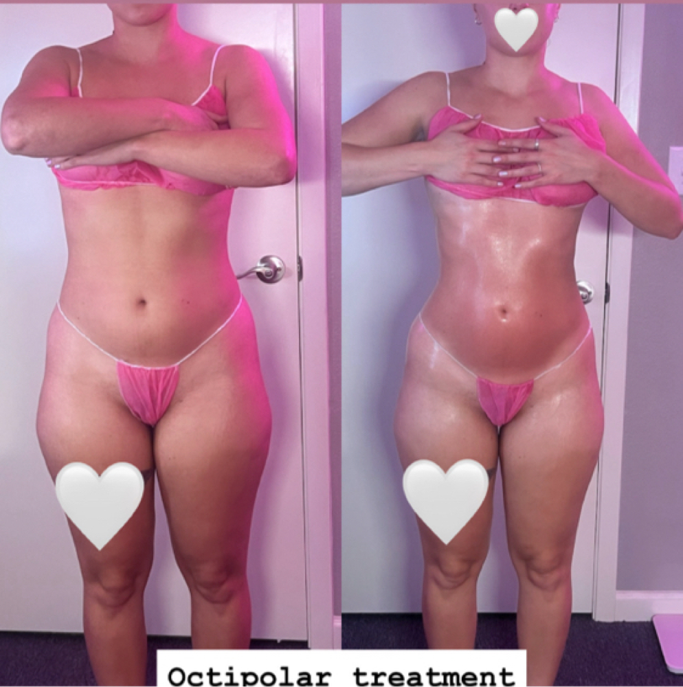 Body Contouring Package at Flawless Spa & Beauty in Fort Worth, TX