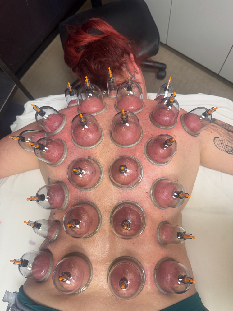 Back Cupping