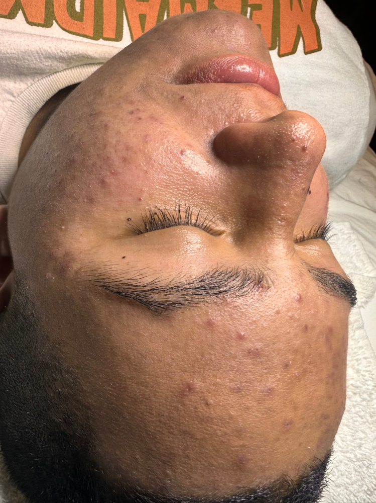Acne Facial