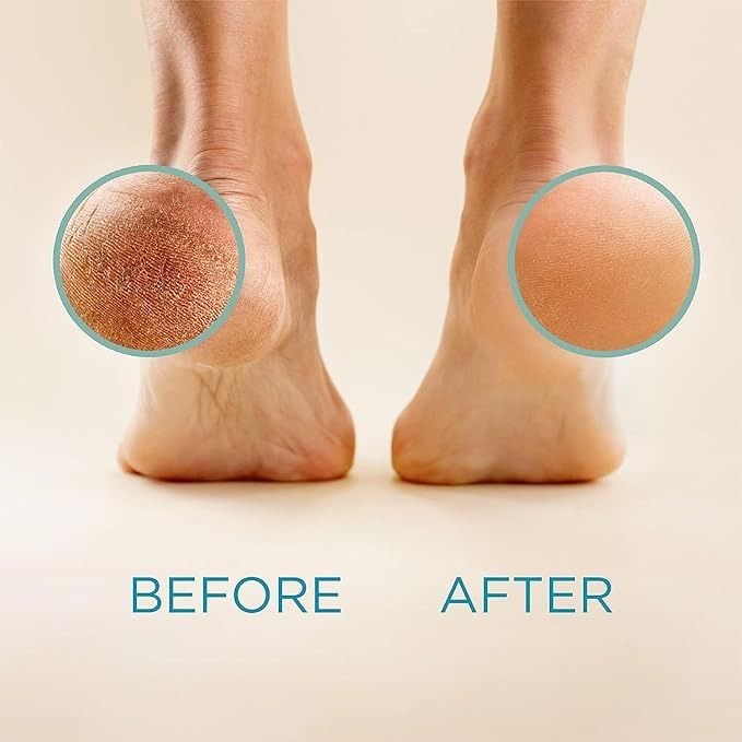 Callus Removal