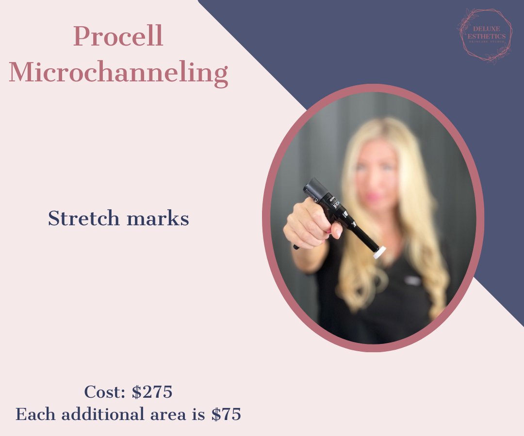 Procell Stretch Mark Treatment