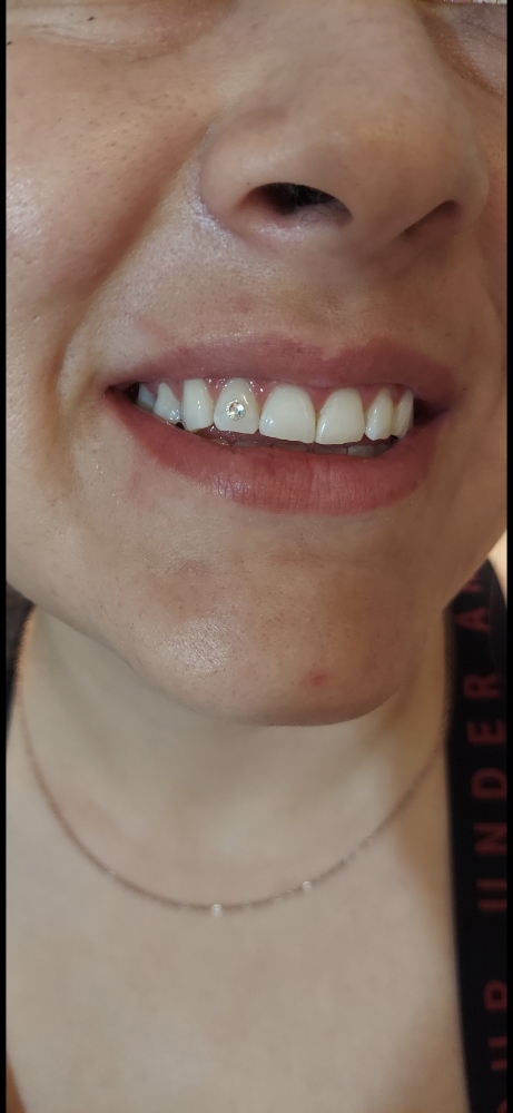Tooth Gems