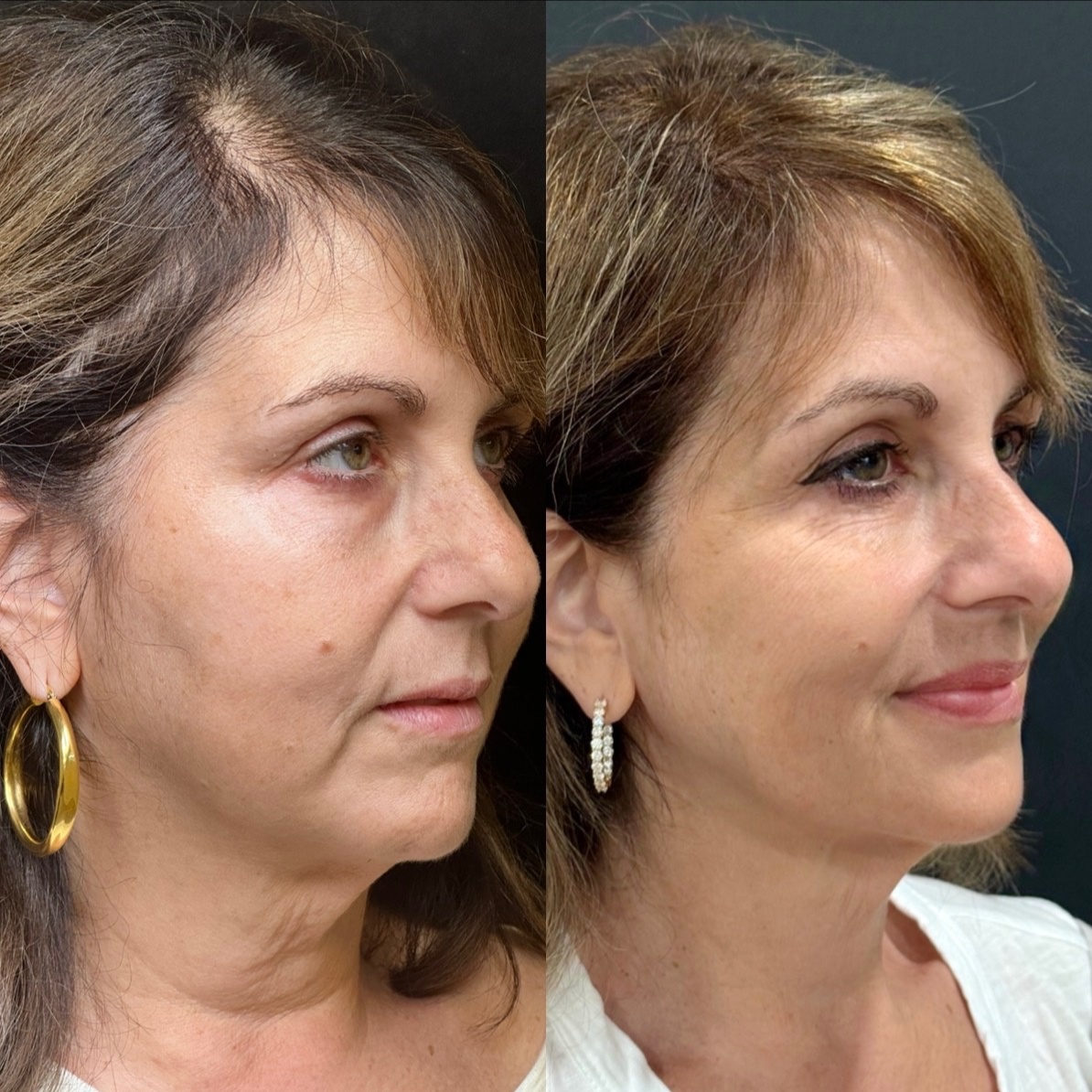Ultherapy at CIAO AESTHETICS in Youngstown, OH