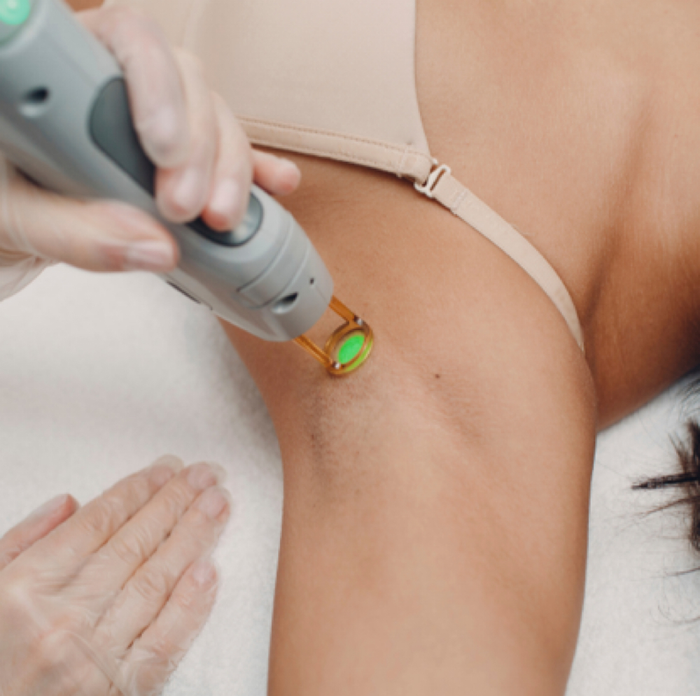 Laser Hair Reduction- Underarms at Joy to Beauty in Jupiter, FL