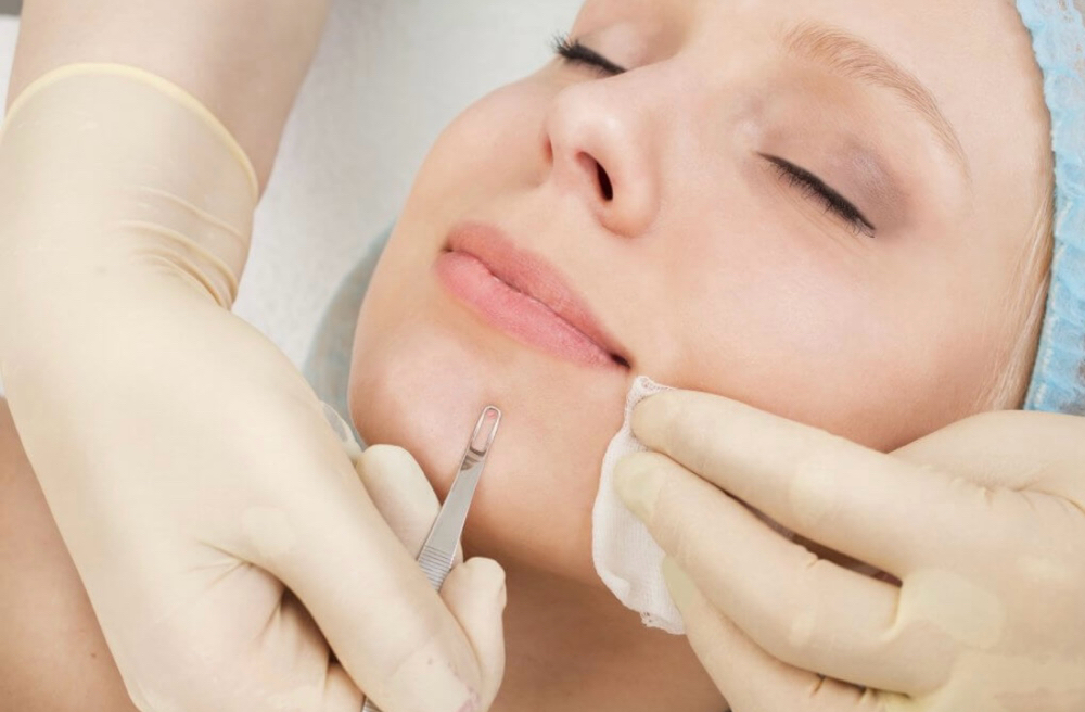 ADD-ON: Comedones Extracton