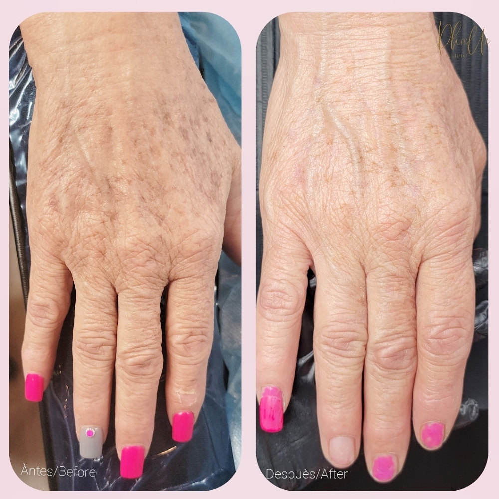 Microneedling Hand Rejuvenation