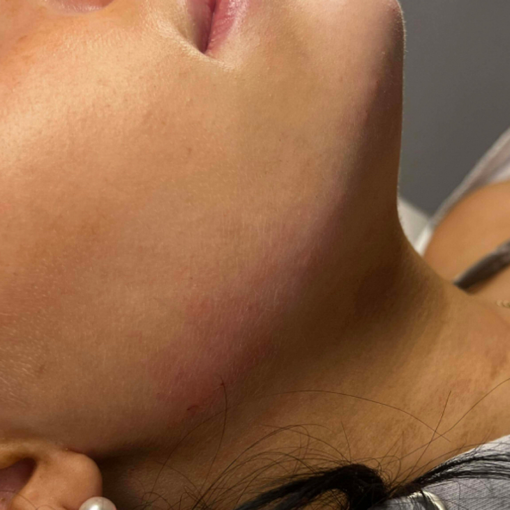 Jawline Botox at Nouvelle Vie Beauty in Cibolo, TX
