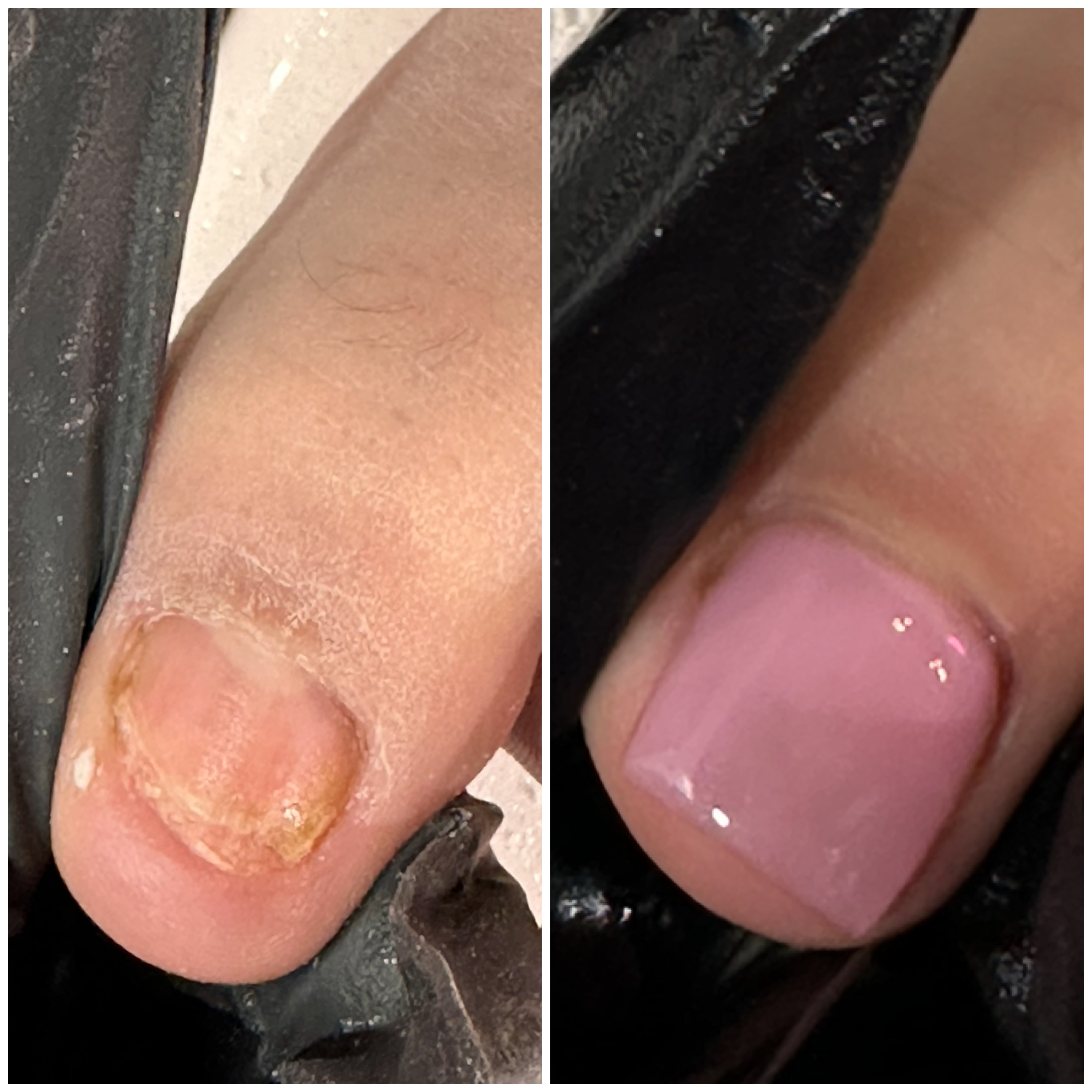 Toenail Bbl / Nail