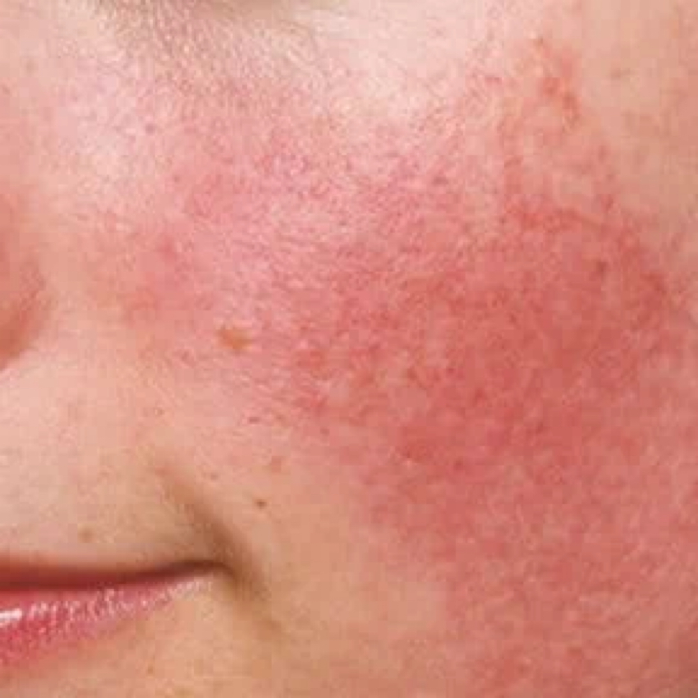 Red + Reactive Reset at Aesthetics by Abby in Alliance, OH