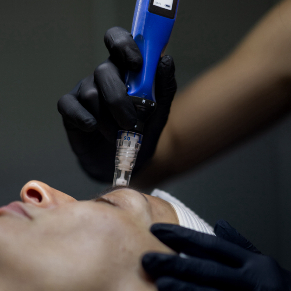 SkinPen Microneedling at Jade Esthetics in Oviedo, FL