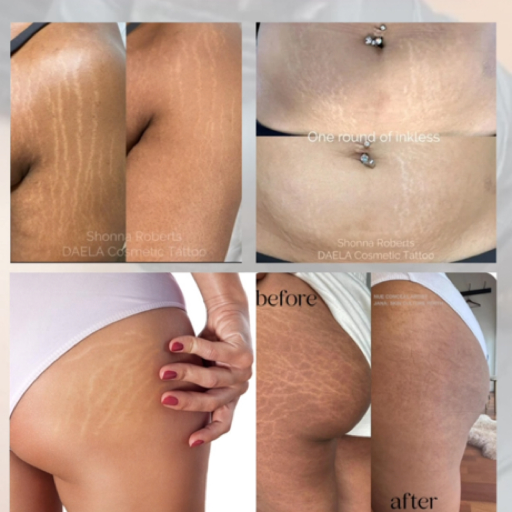 Inkless Scar Revision