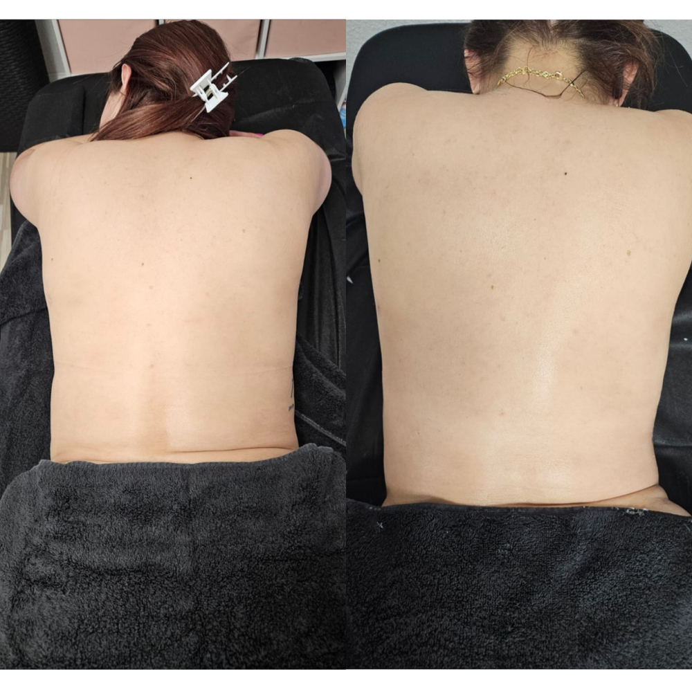 Cavitation & RF Massage