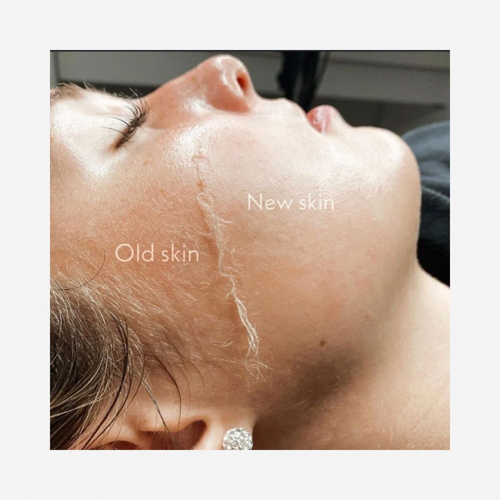 Dermaplaning