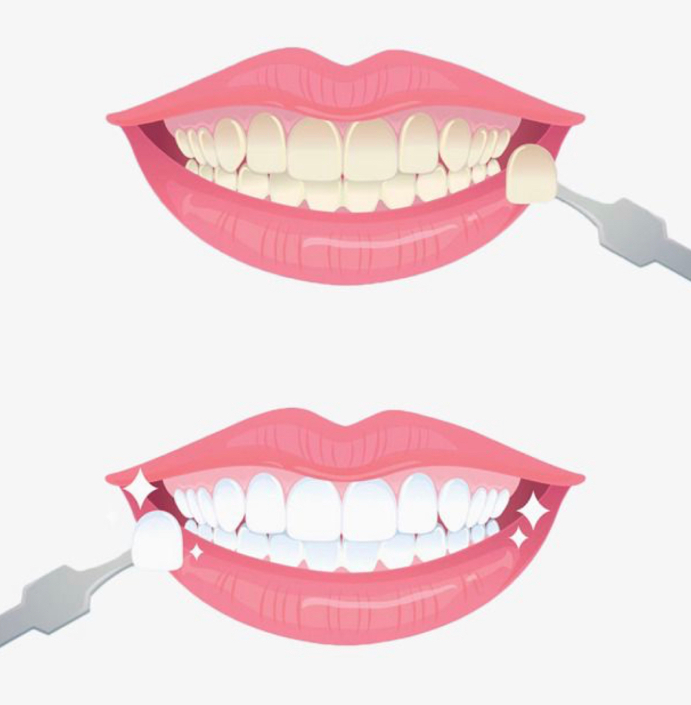 Blanquemiento Dental (3 Sesiones)