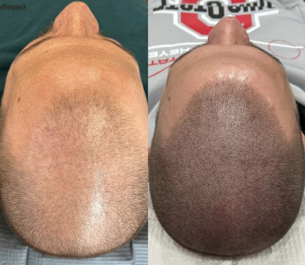 Scalp Micropigmentation