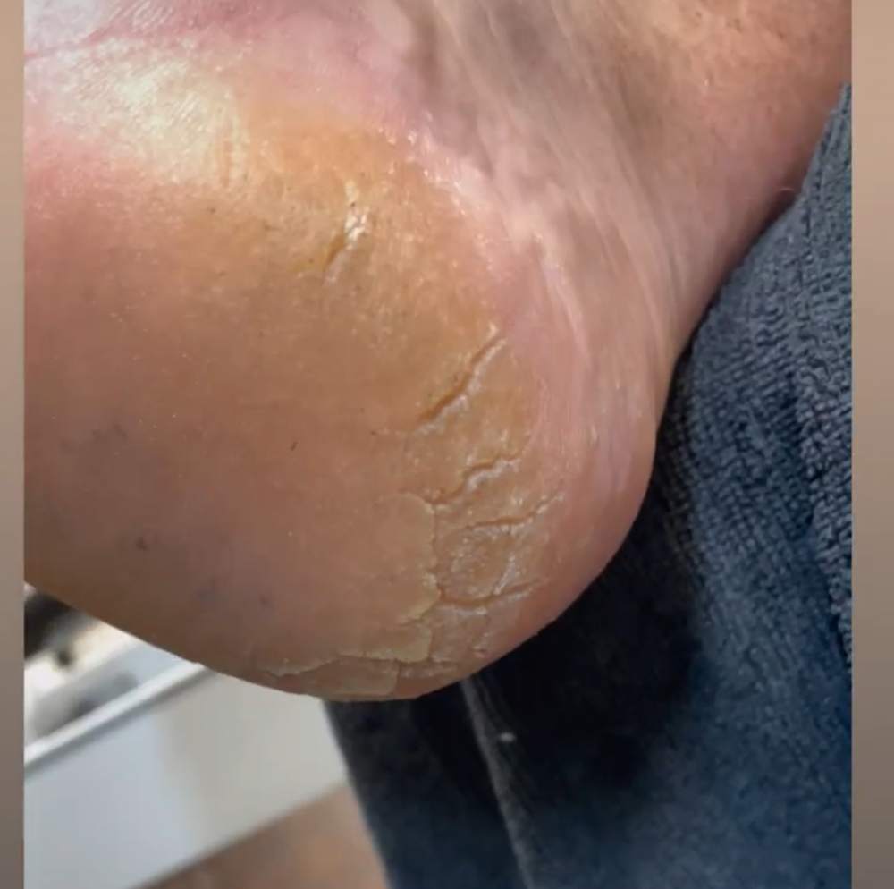 Footlogix dry/cracked heel pedicure