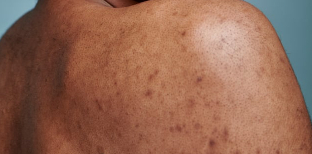 Hyperpigmentation Revision