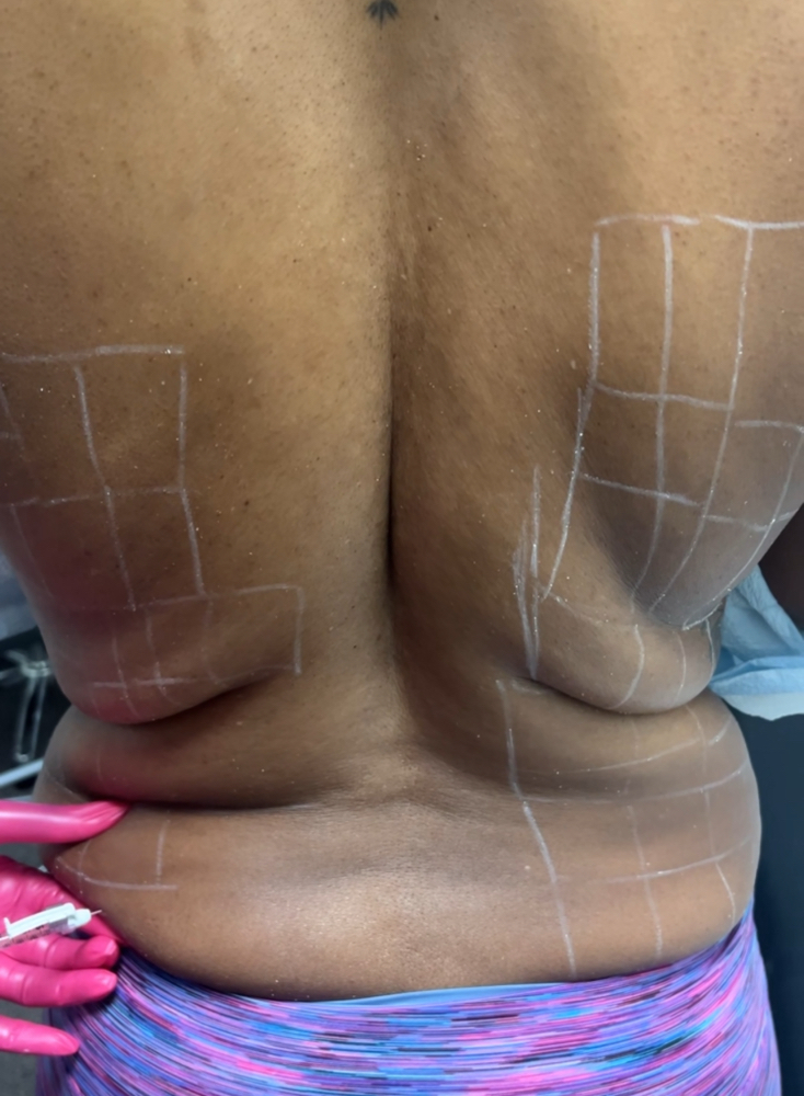 Liquid Lipo Back