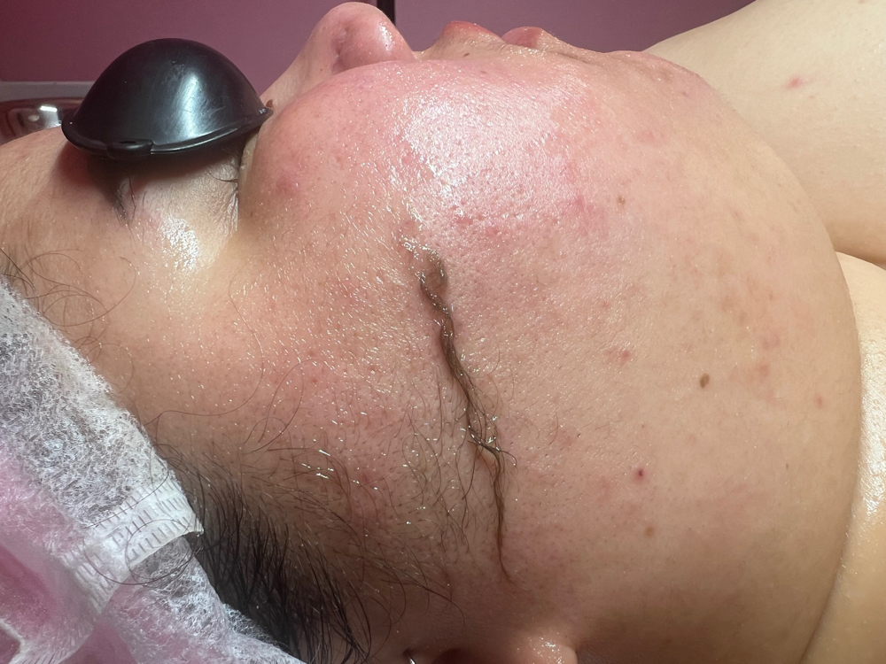 Dermaplaning Facial