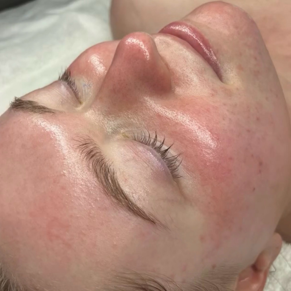 Vitamin A Peel at Skin Alchemy in South Charleston, WV