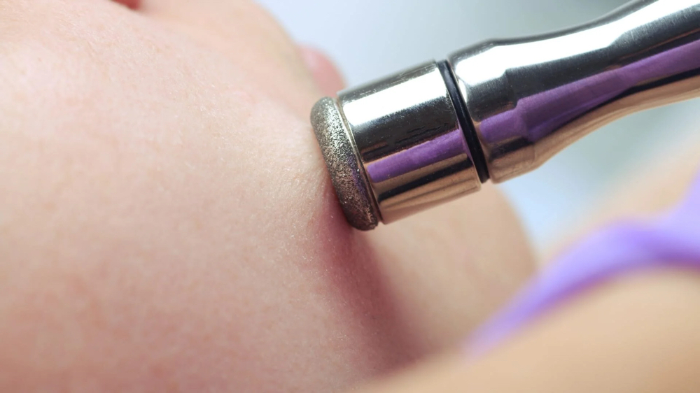 Microdermabrasion at OhMyGlow Beauty Esthetics in Fort Lupton, CO