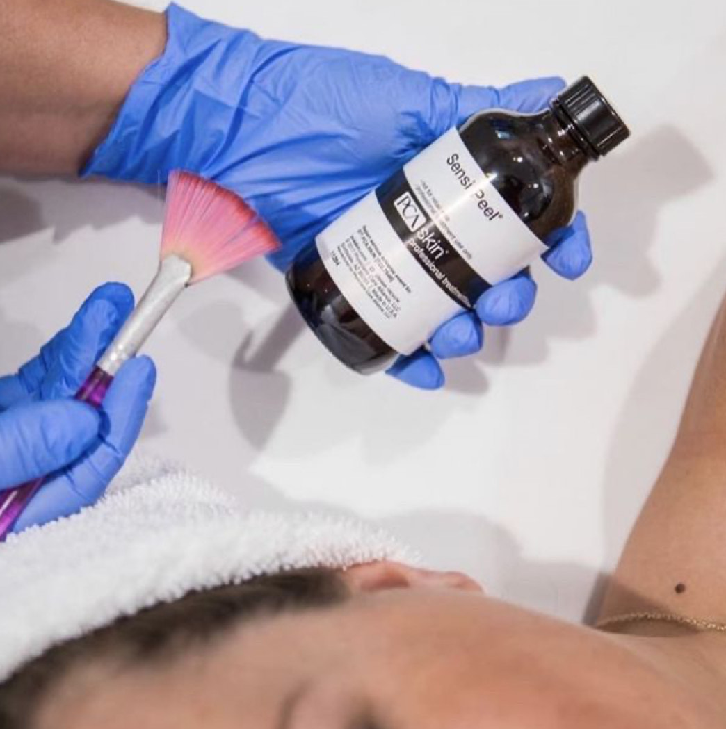 Chemical Peel