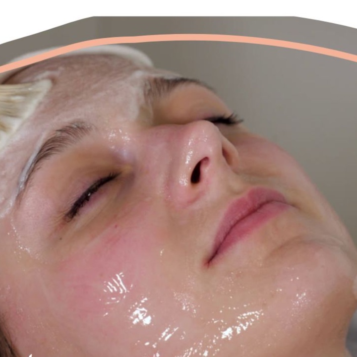 Rosacea Facial