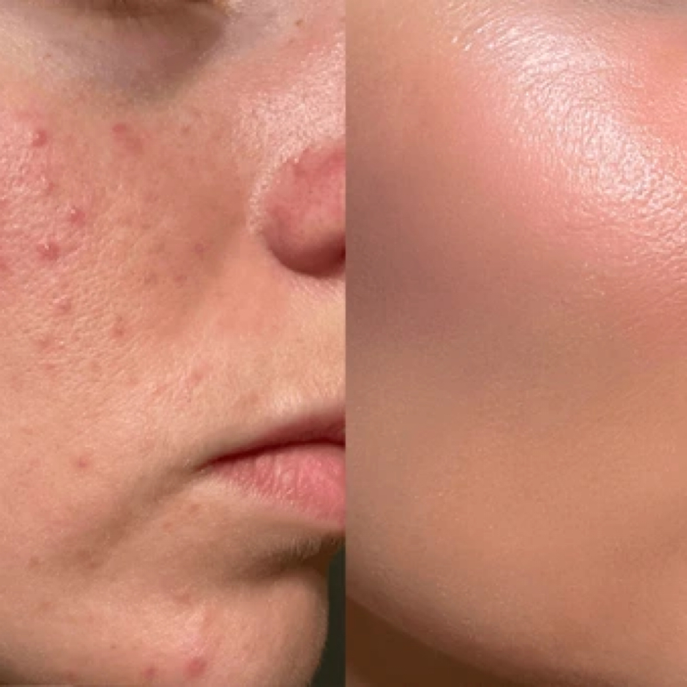 Acne Facial at Refined Esthetics Co. in Chicago, IL