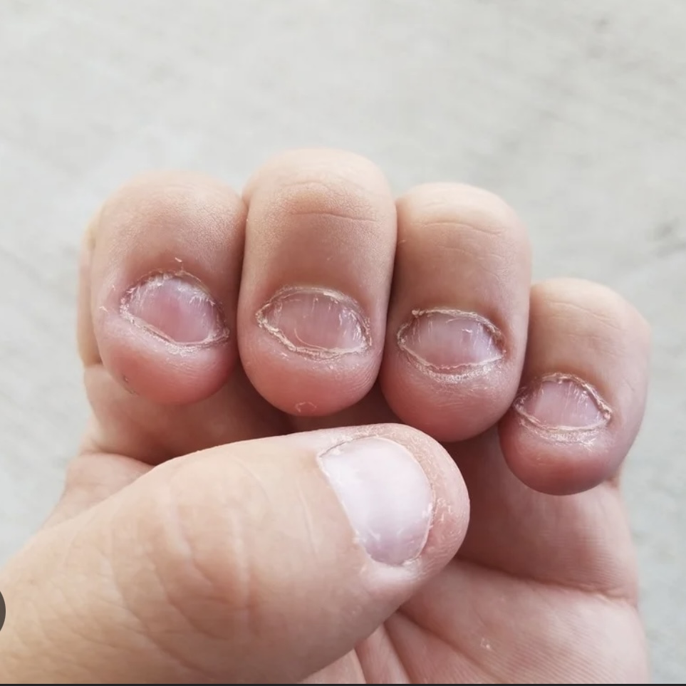 Nail Biting Foundation Add-On – $10