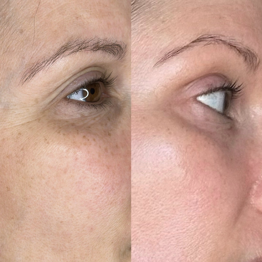 Upper Face Lift at Magnolia Plasma Fibroblasting By Mitra in Frisco, TX
