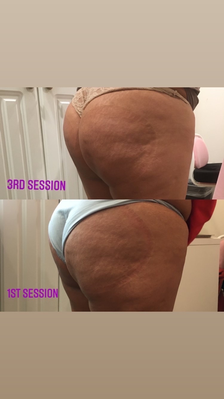 Booty Lift Session
