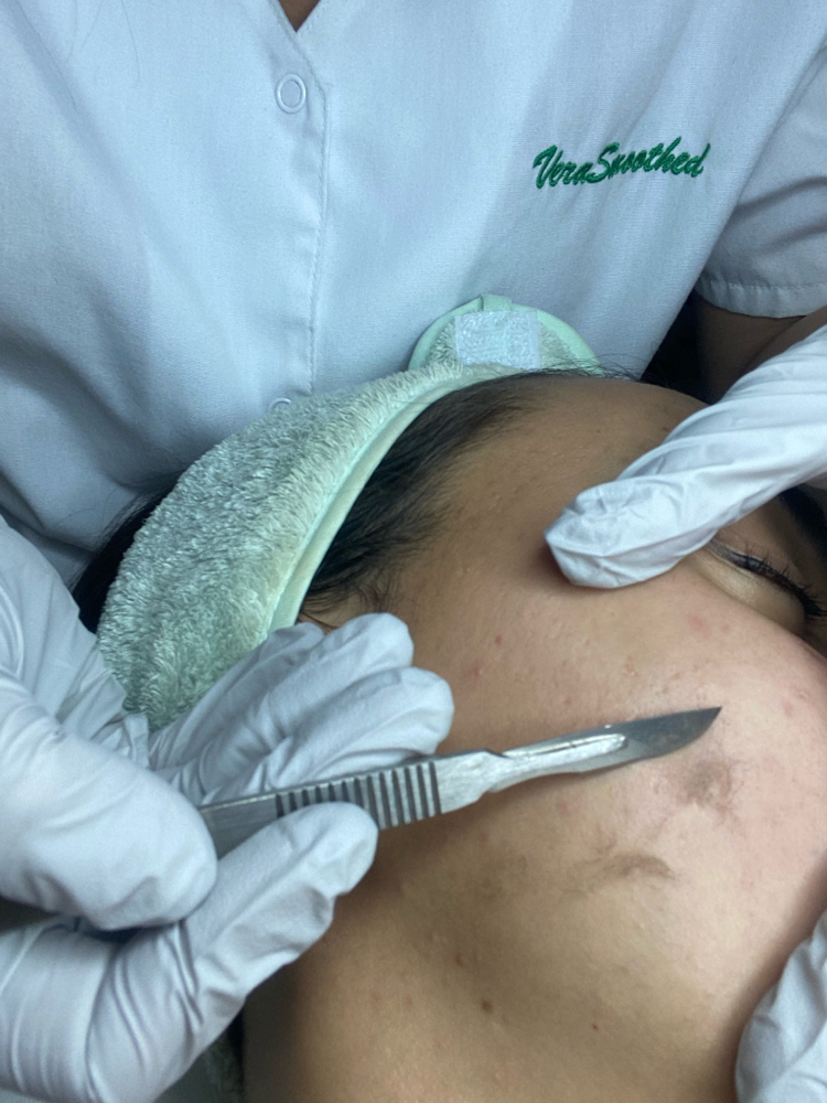 Dermaplaning