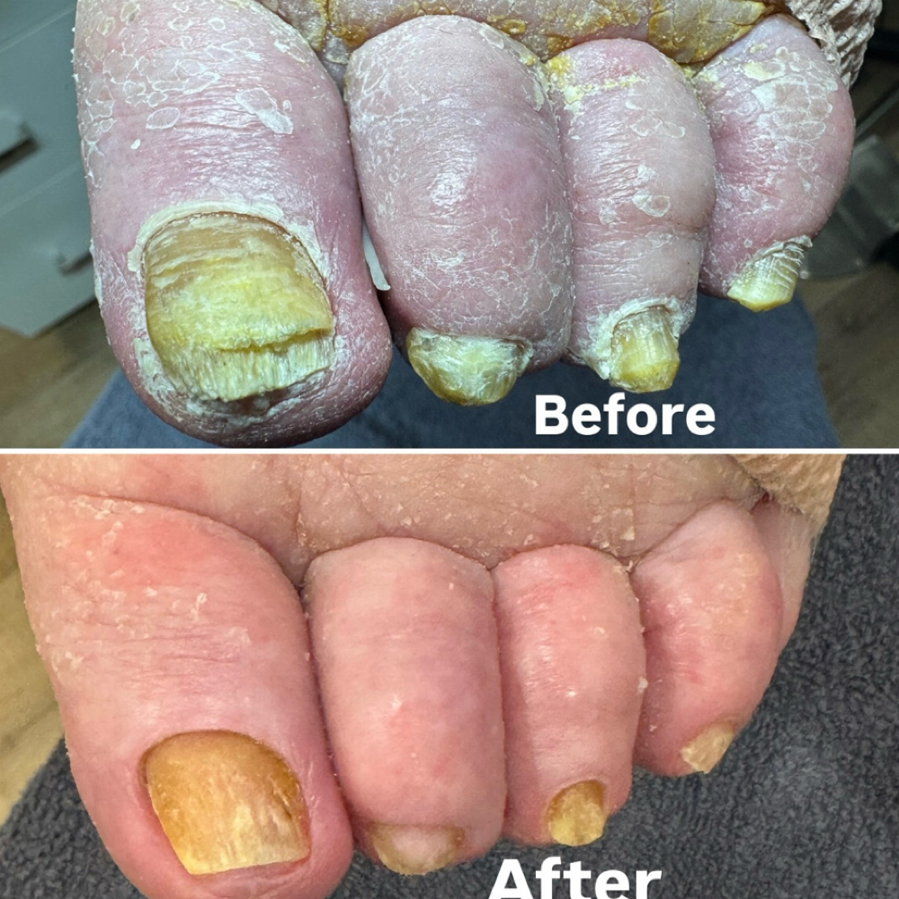 Fungal Deep Clean + Reconstruction at Southern Oregon PEDICURE CLINIC in Medford, OR