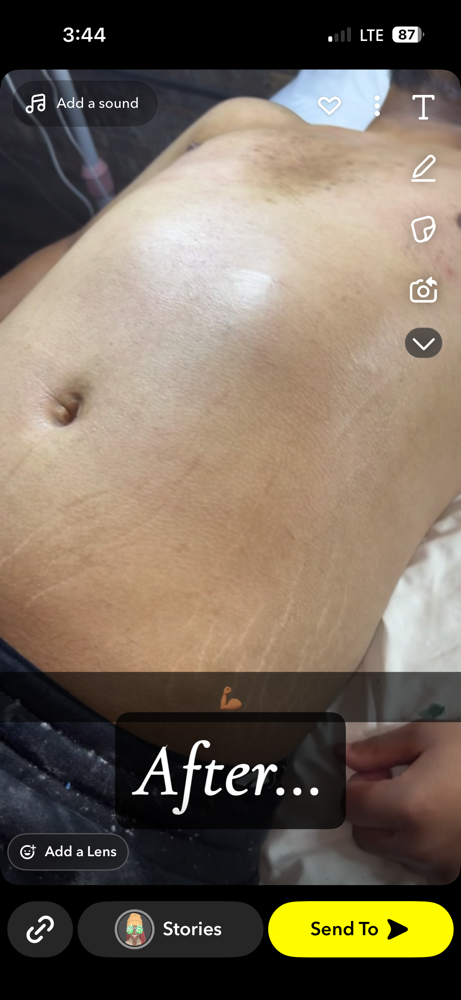 Chest Wax at Runway Esthetics in Racine, WI