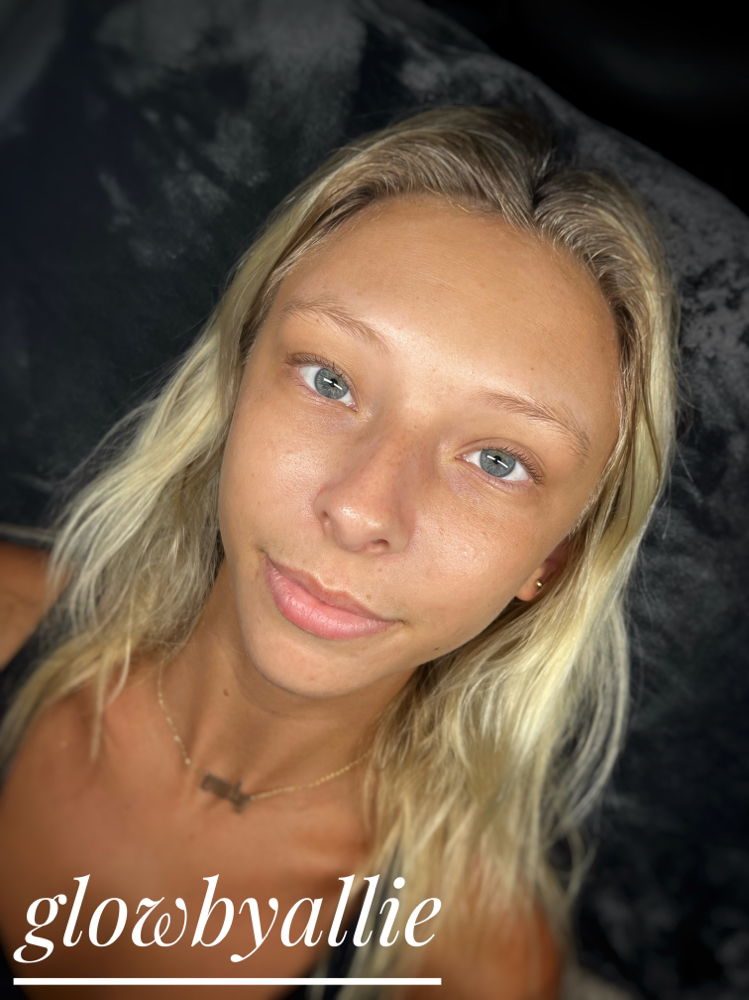 Microdermabrasion Facial