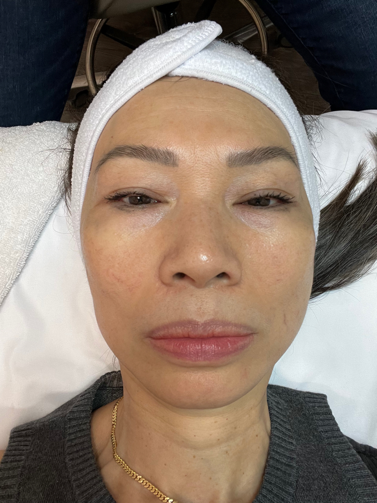 Bio Microneedling