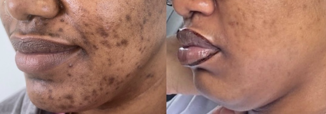 Acne Chemical Peel at Jontahontas’ Collection LLC. in Greenville, SC