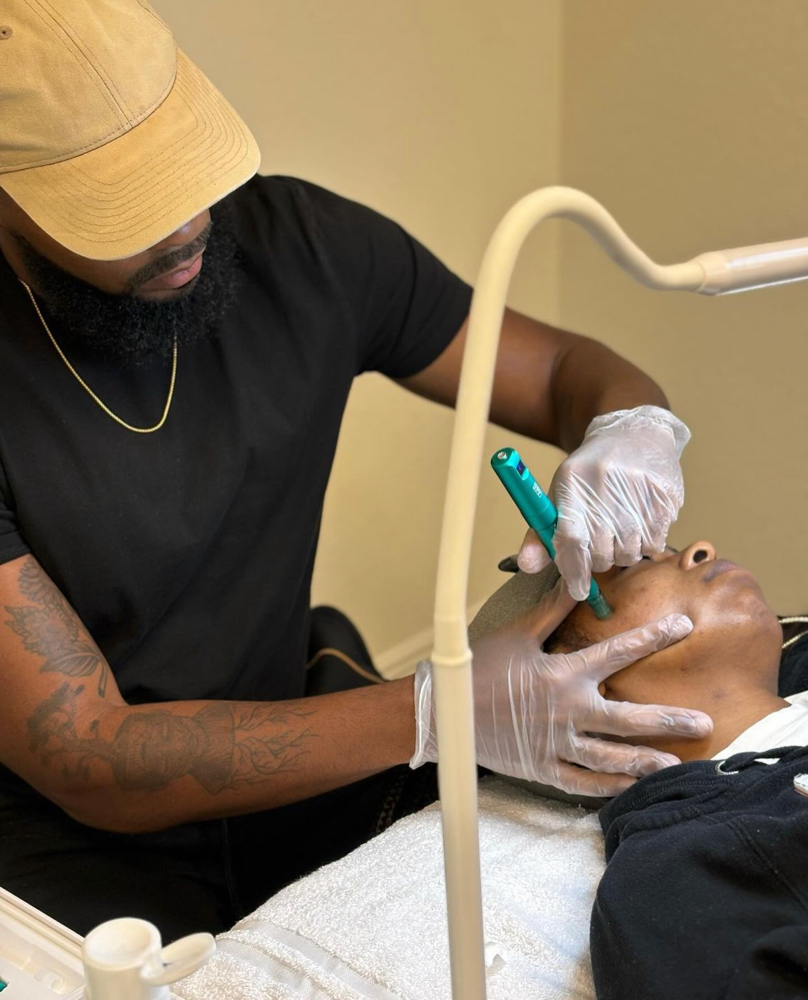 Microneedling