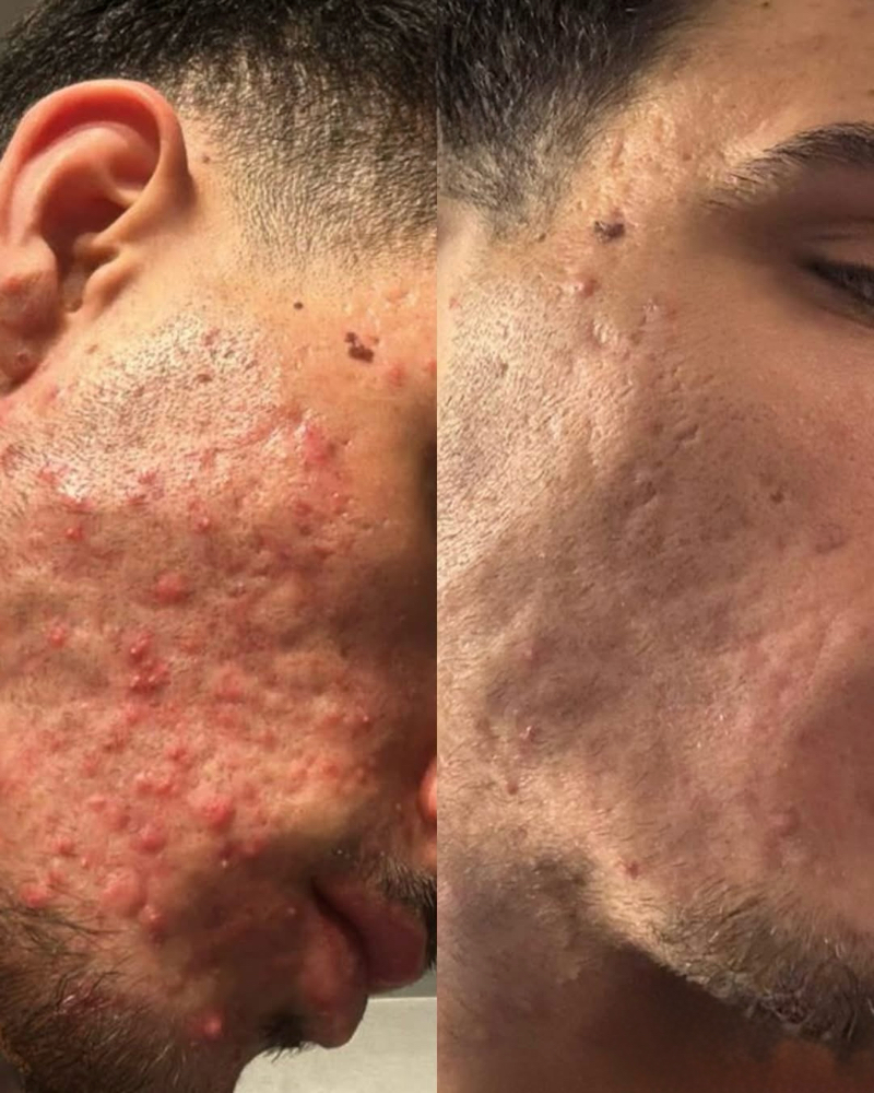 Plasma treatment for facial wrinkle