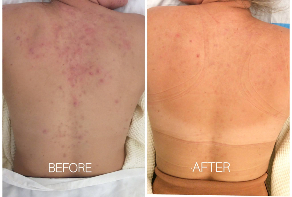 Bi Weekly Back Acne  Facial