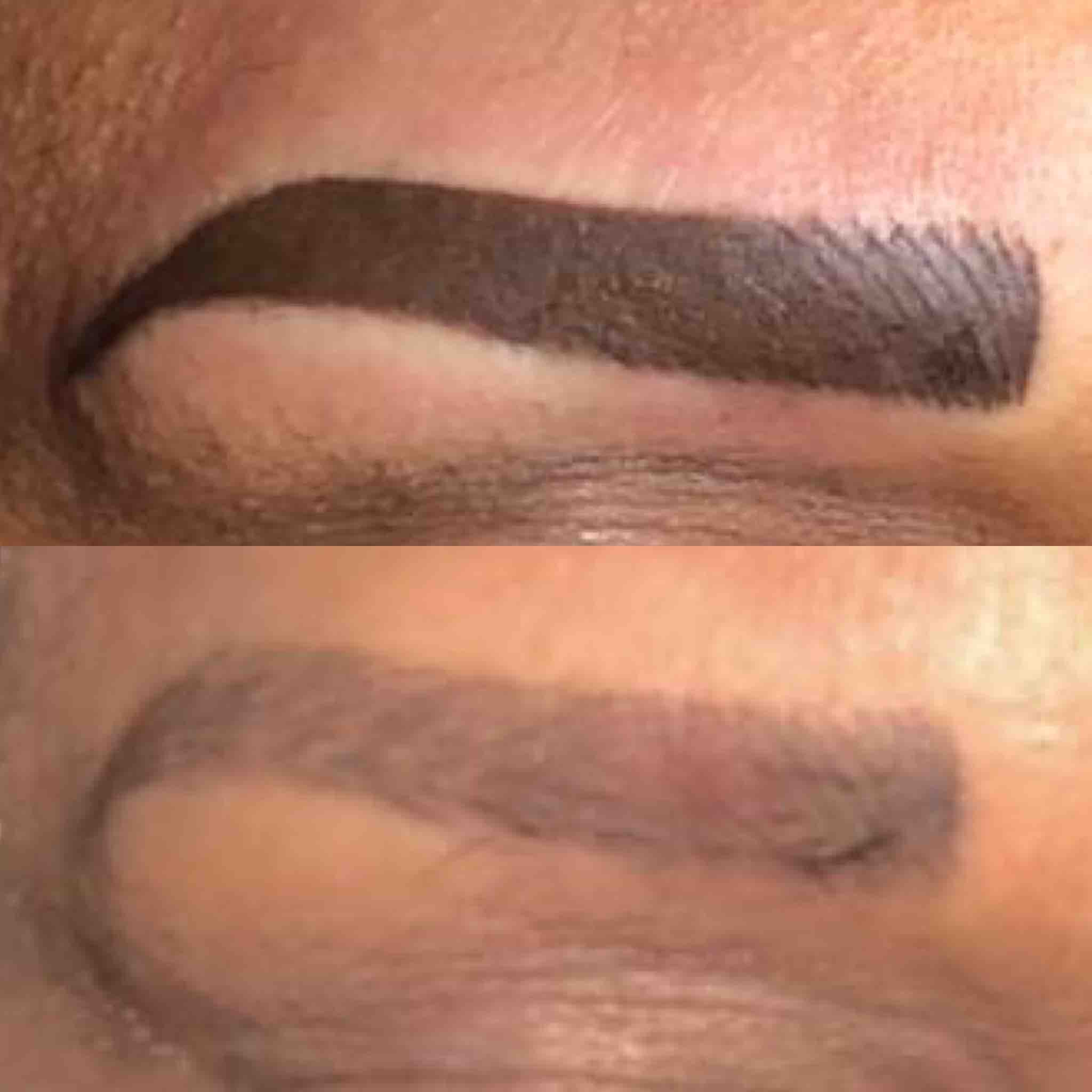 Permanent Makeup Lightening/Removal