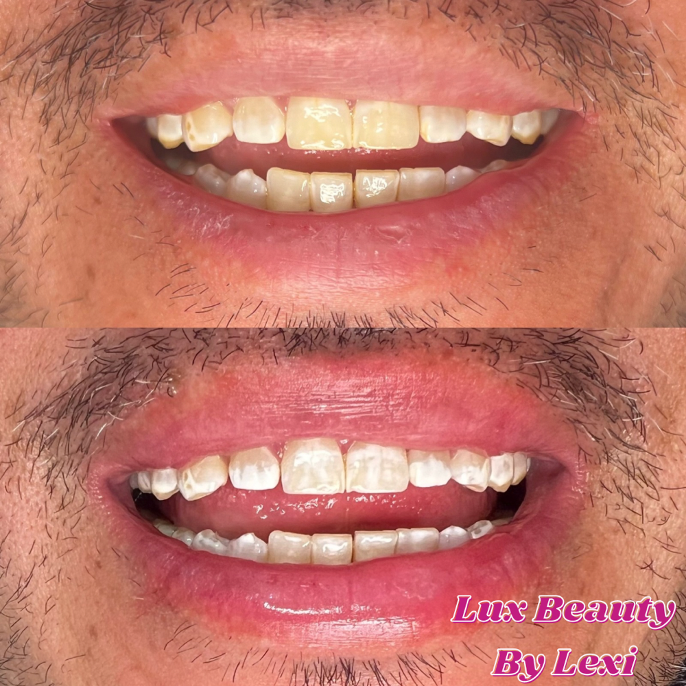 60min Teeth Whitening
