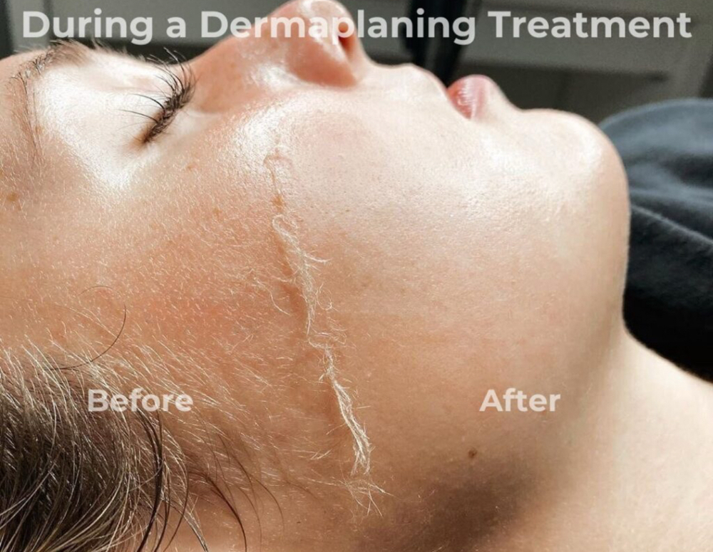 Dermaplaning at Nellies Beauty Bar in Phoenix, AZ