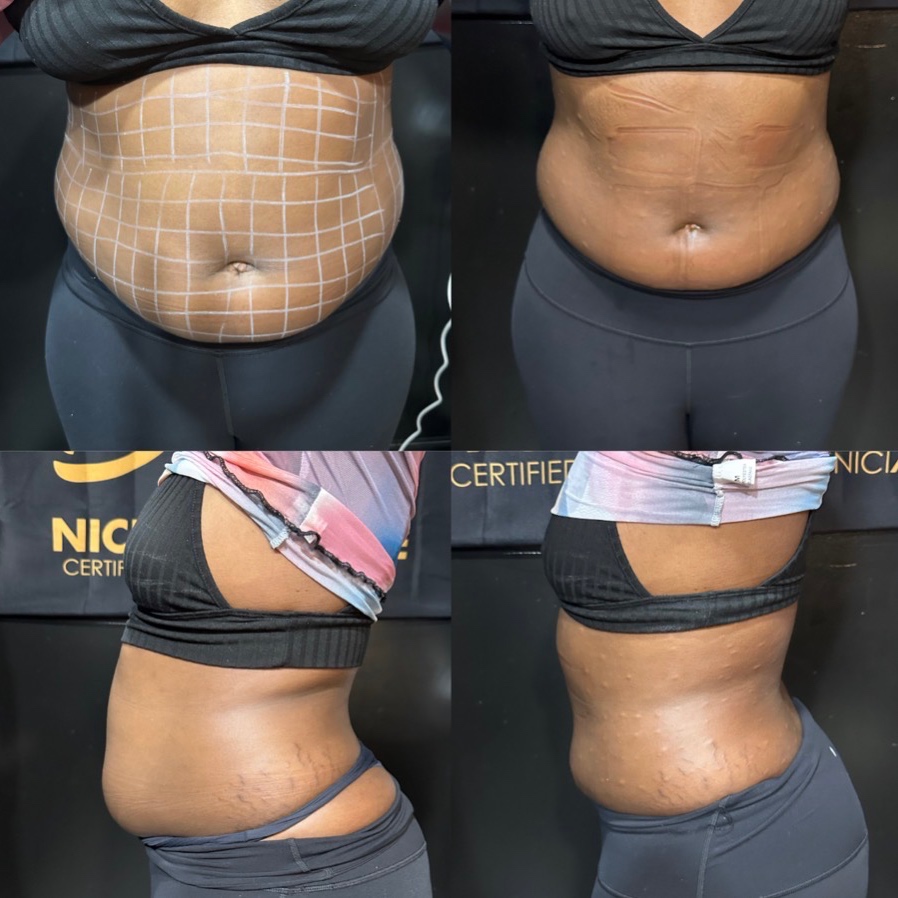 DOUBLE DOSE LIPO SHOT at BODIEDBYNICKEI LLC in The Bronx, NY