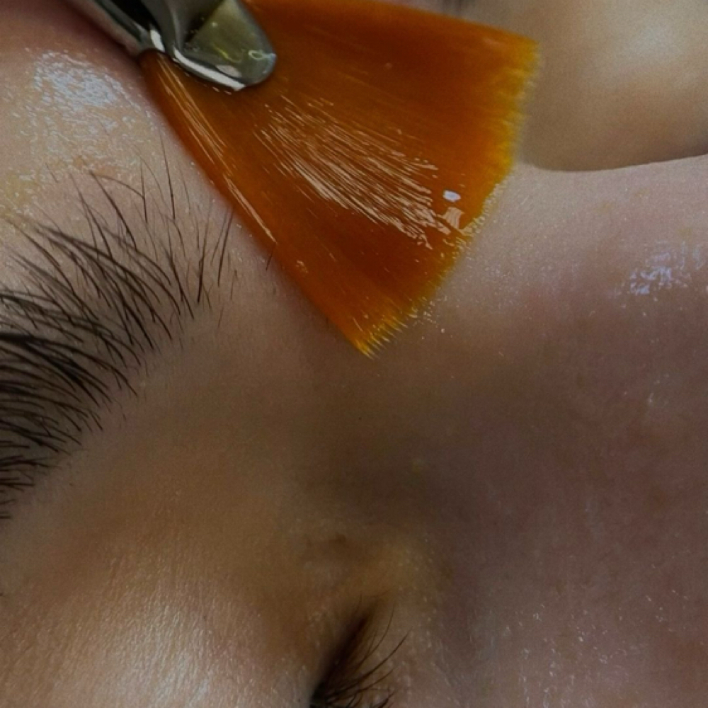 Acne-Clear Peel at 121 Studio in Marshall, IL